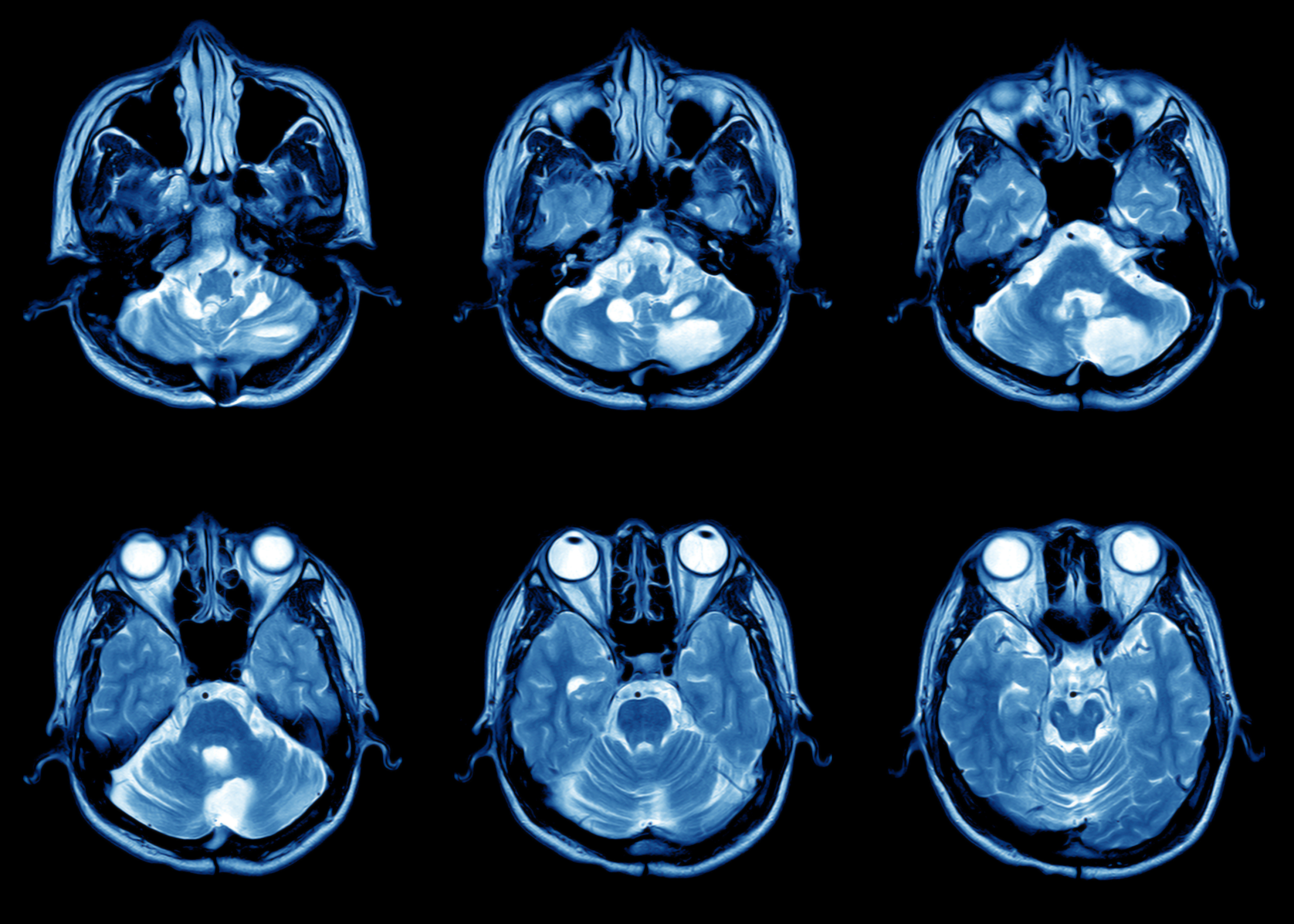 Image of brain MRI scan
